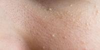 Демодекоз или подкожный клещ на лице: симптомы, стадии, лечение